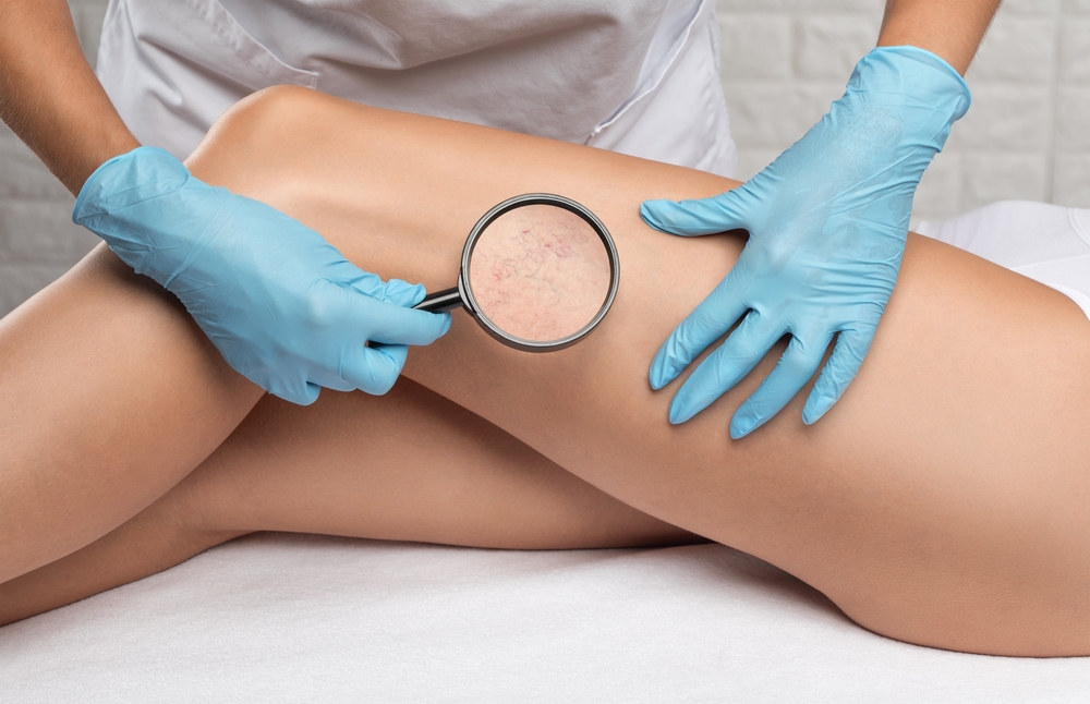 Effective Lifestyle Changes for Managing Varicose Veins