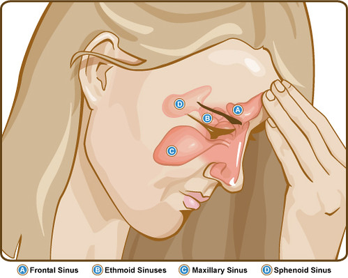 How To Tell if You Have Sinusitis and When To Seek Treatment