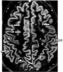 MRI and Its Role in Detecting Multiple Sclerosis