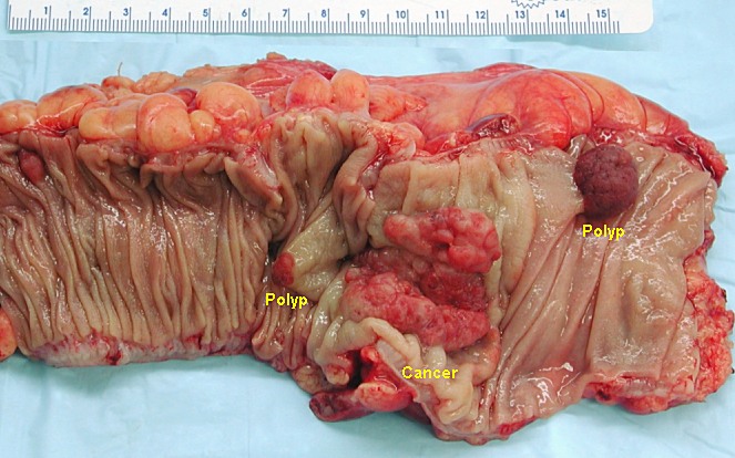The Importance of Early Detection in Colon Cancer