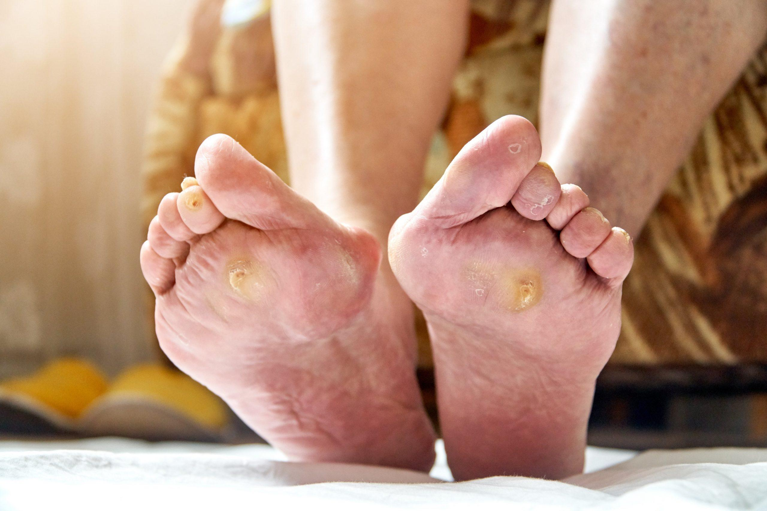 How to Prevent Foot Ulcers in Diabetics: A Complete Guide