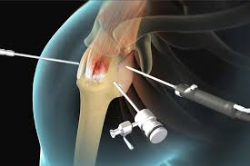 When to Consider Shoulder Surgery for Rotator Cuff Injury