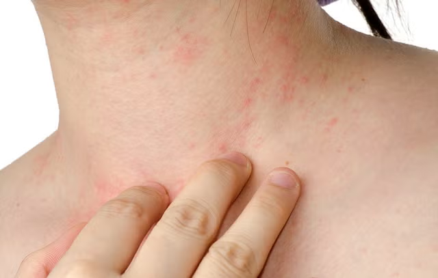 How to Treat Eczema Flare-Ups Naturally