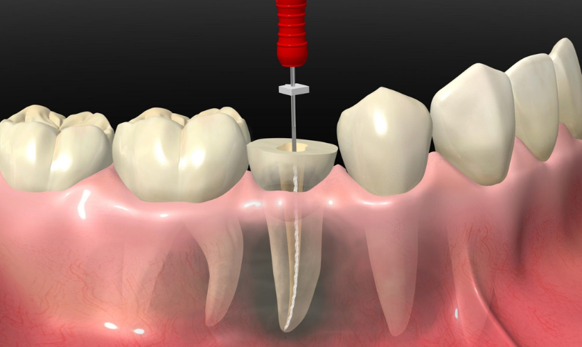 What to Expect During a Root Canal Procedure