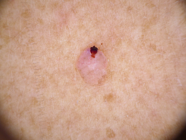 Benign Skin Moles Versus Malignant Skin Moles
