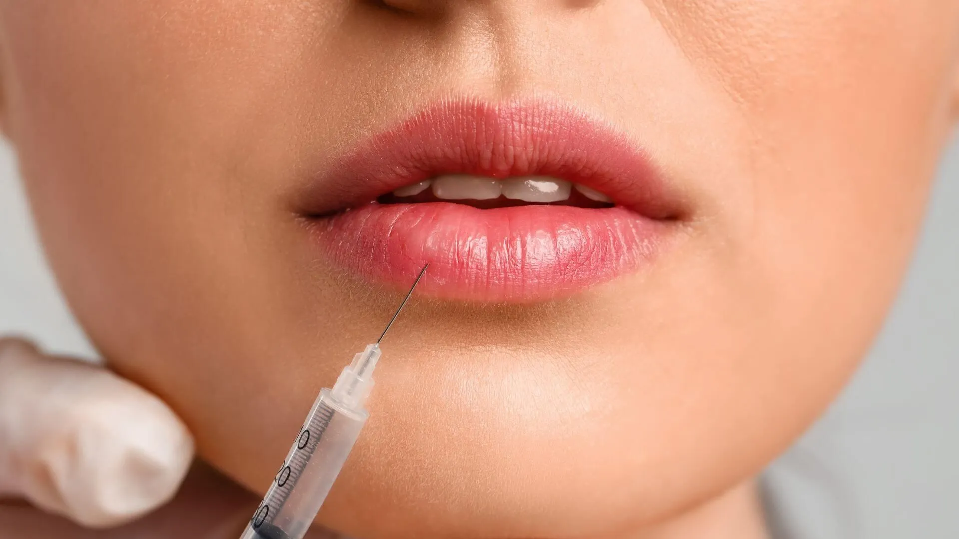 How Dermal Fillers Can Enhance Your Natural Features