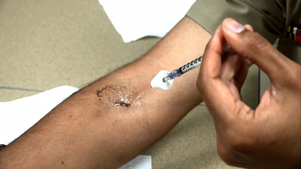 How Is Eczema Treated?