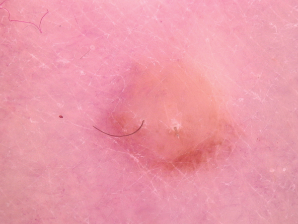 How To Treat Skin Cancer After Your Diagnosis
