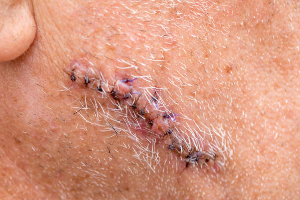 Mohs Surgery Versus Traditional Excision