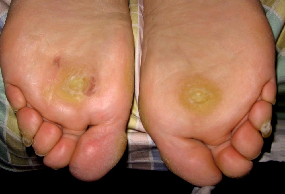 Natural Remedies for Treating Plantar Warts