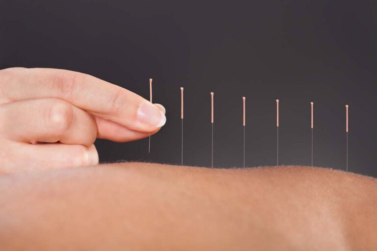 The Benefits of Acupuncture for Pain Relief
