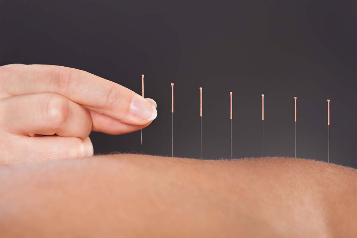 The Benefits of Acupuncture for Pain Relief