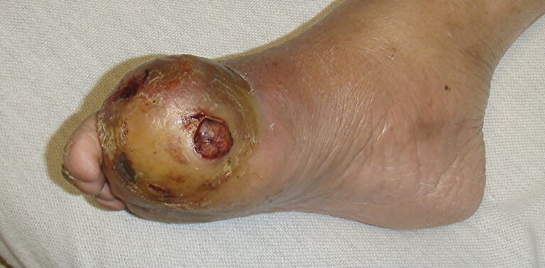 The Impact of Venous Ulcers and How to Manage Them Effectively