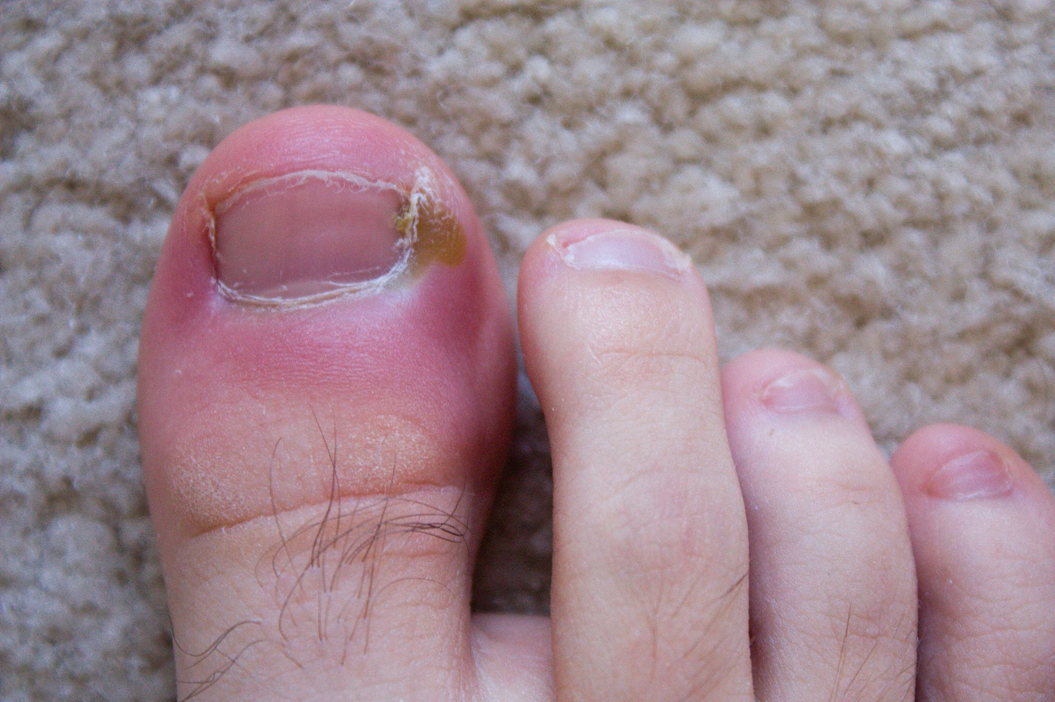 What Are the Causes of an Ingrown Toenail?