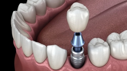 What Makes Dental Implants a Durable Solution for Missing Teeth