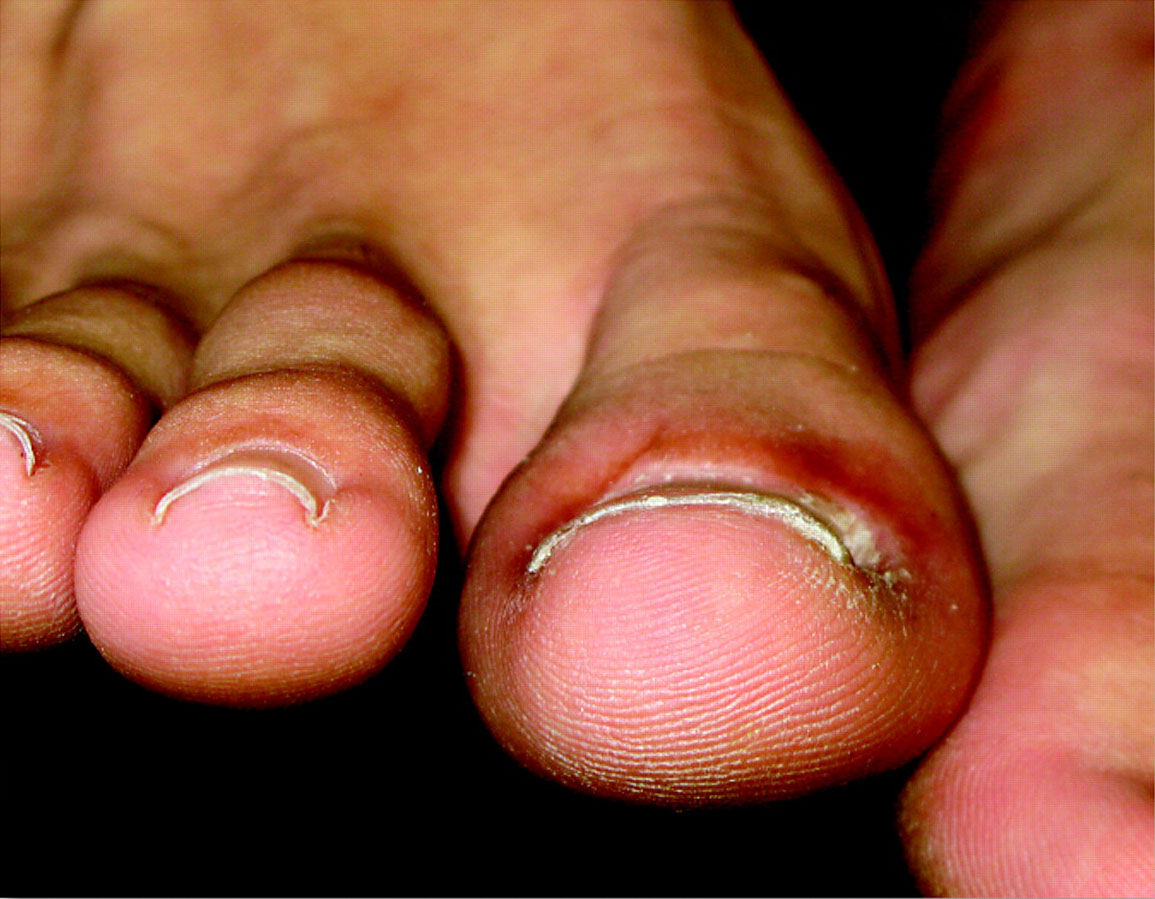 What to Know About Diabetes and Ingrown Toenails
