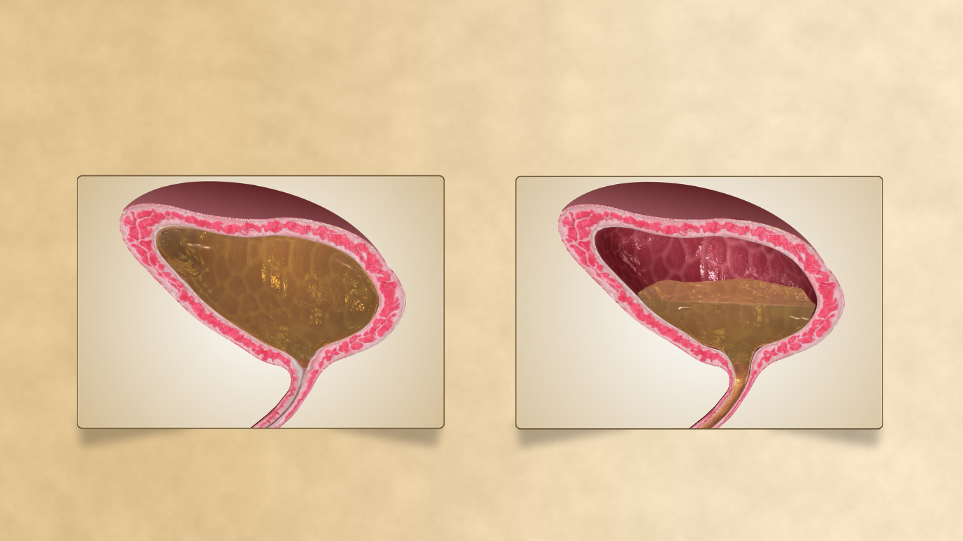 3 Things To Know About Urinary Incontinence
