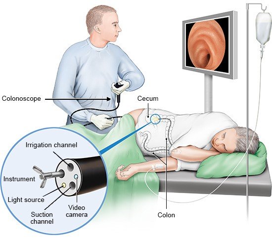 Reasons To Get a Colonoscopy