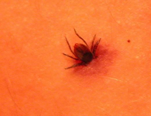 The Connection Between Lyme Disease and Co-Infections