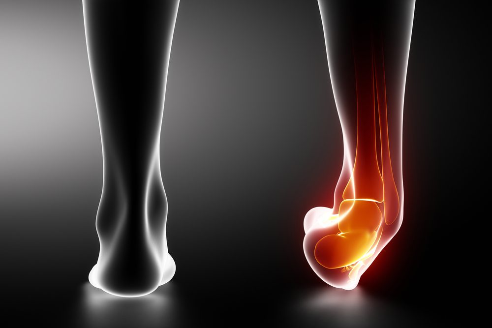 The Long-Term Effects of Untreated Ankle Sprains