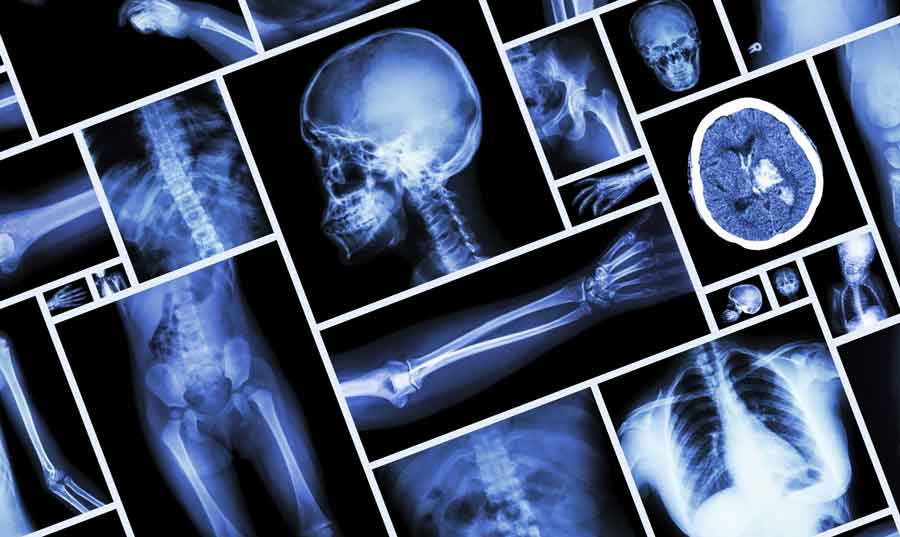 Understanding Fracture Treatment and Bone Healing