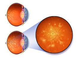 What to Expect During a Diabetic Eye Exam