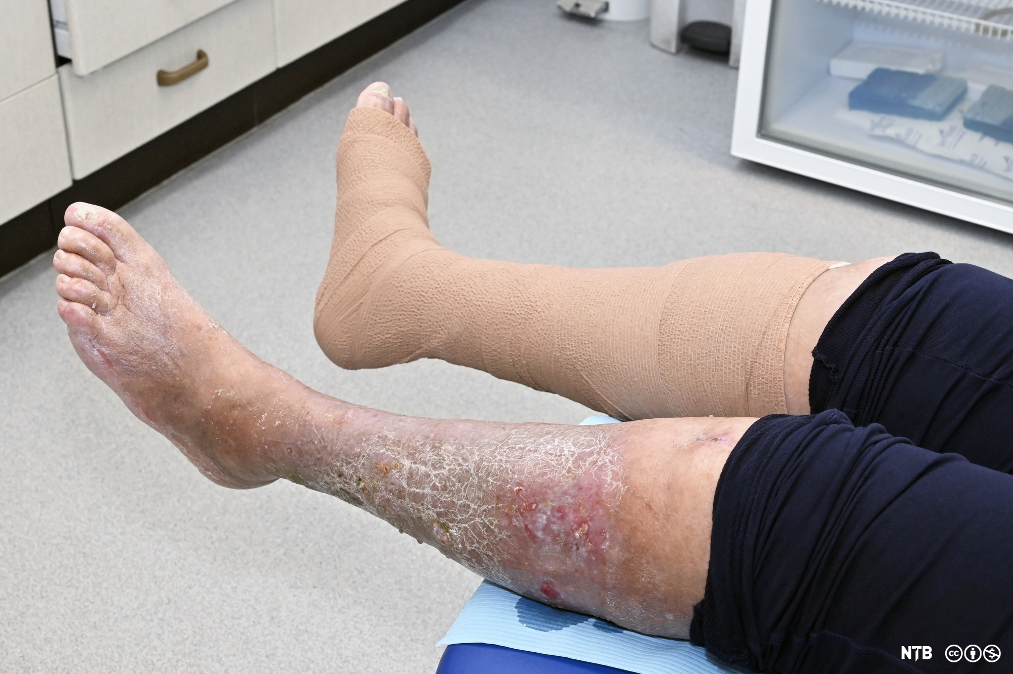 Why Won’t My Leg Wound Heal?