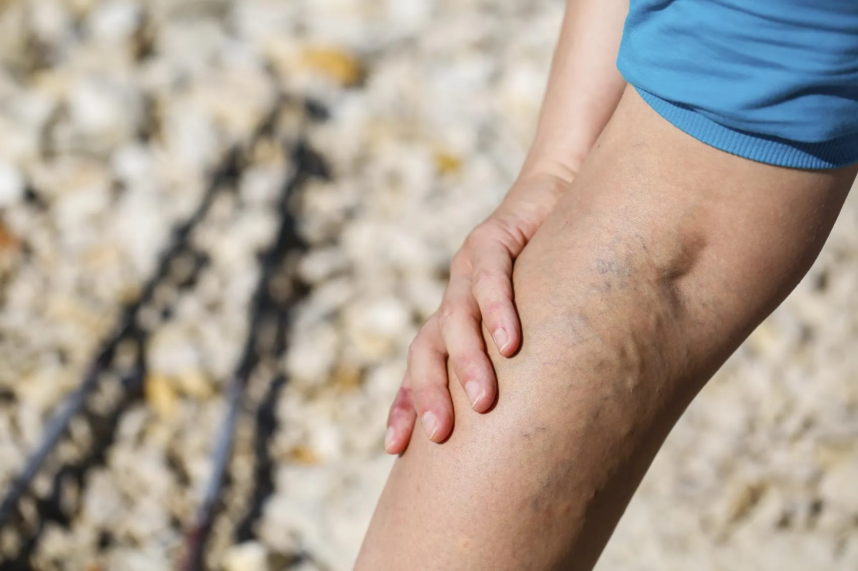 How Spider Veins Differ from Varicose Veins