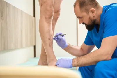 Managing Symptoms and Treatment Options for Varicose Veins