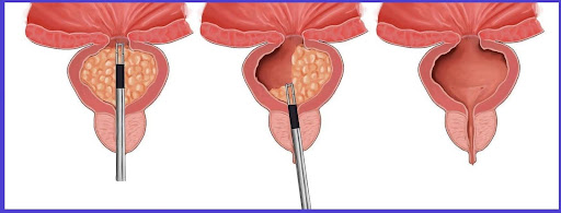 Managing Symptoms of an Enlarged Prostate