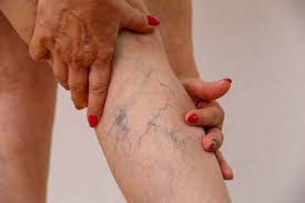 Recognizing the Symptoms and Treatments of Varicose Veins