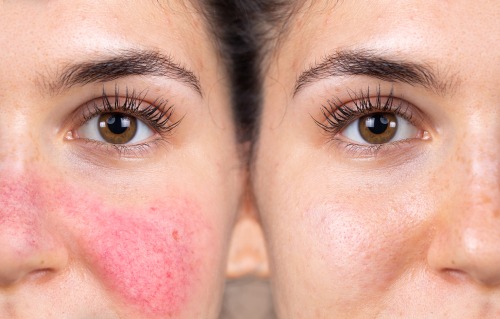 The Benefits of Seeing a Dermatologist for Rosacea Management