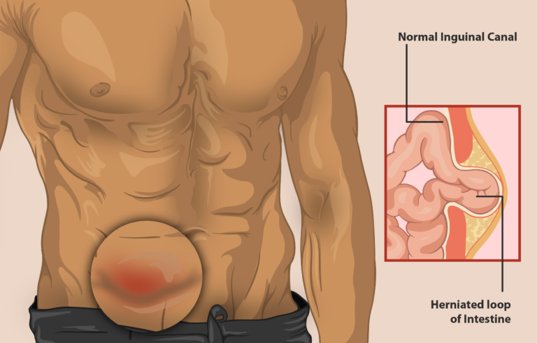 Understanding the Different Types of Hernias and Their Symptoms