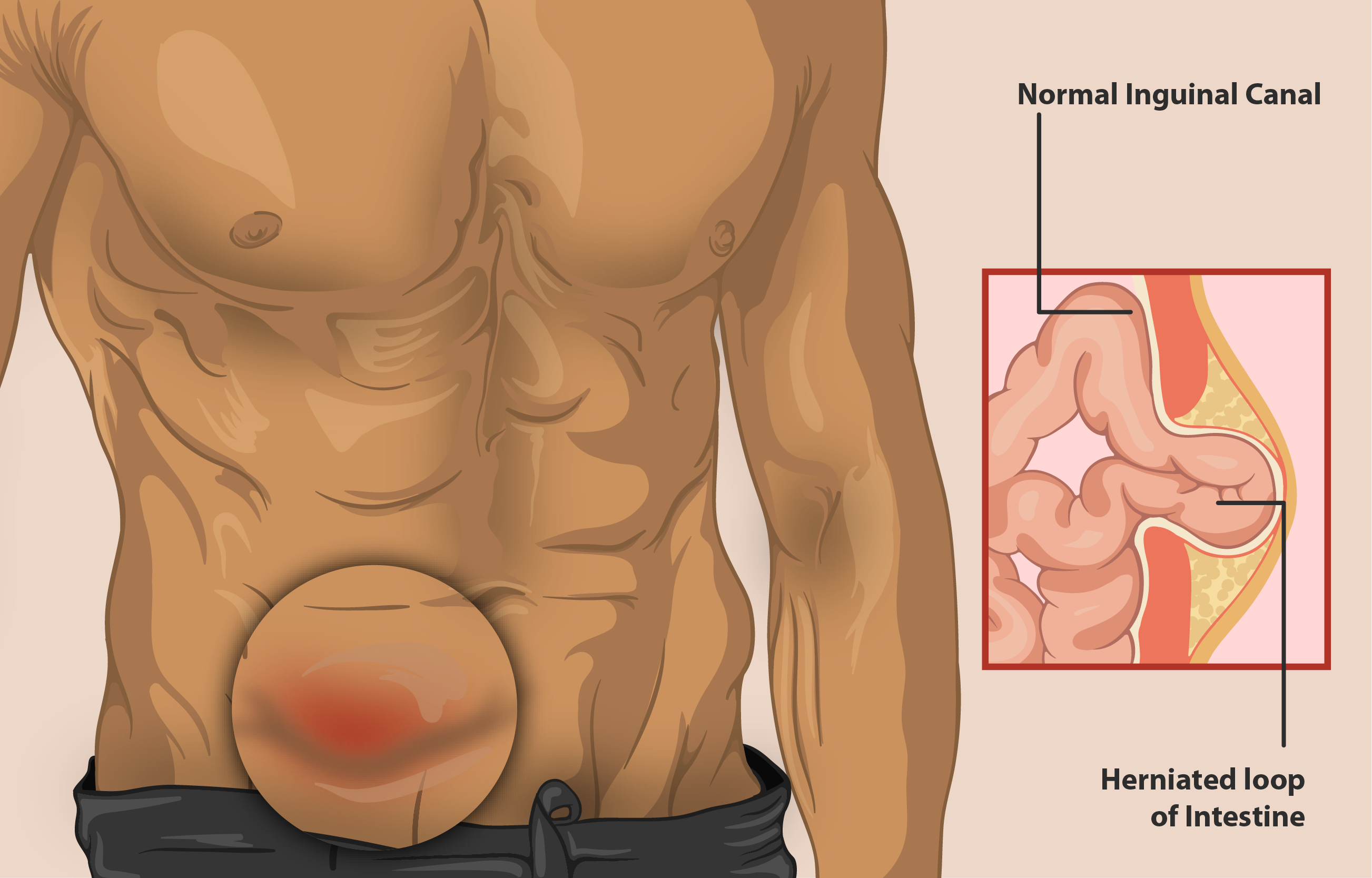 Understanding the Different Types of Hernias and Their Symptoms