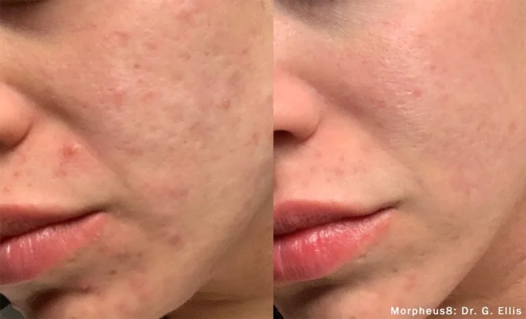 Ways Morpheus8 Helps With Skin Rejuvenation