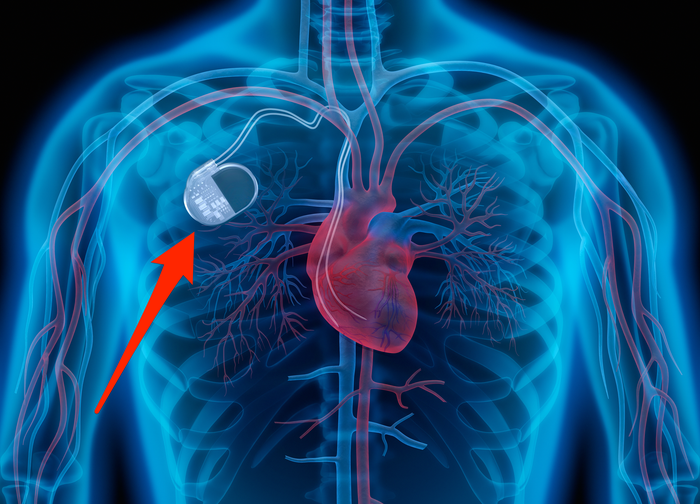 What Patients Should Know About Pacemakers