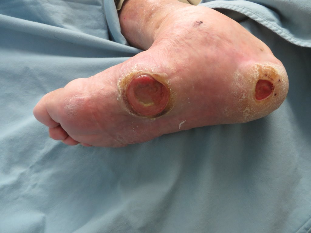 he Connection Between Diabetes and Foot Ulcers