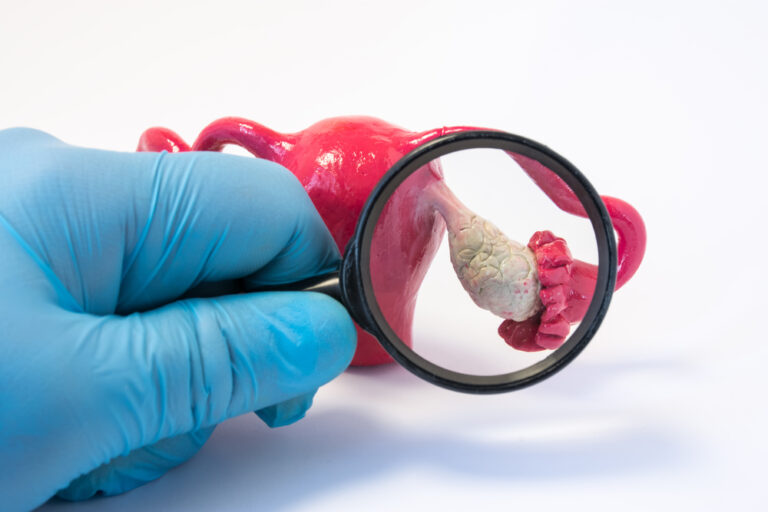 What To Know About PCOS