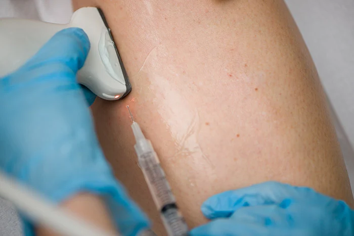 A Comprehensive Guide to the Popular Spider Vein Treatment: Sclerotherapy