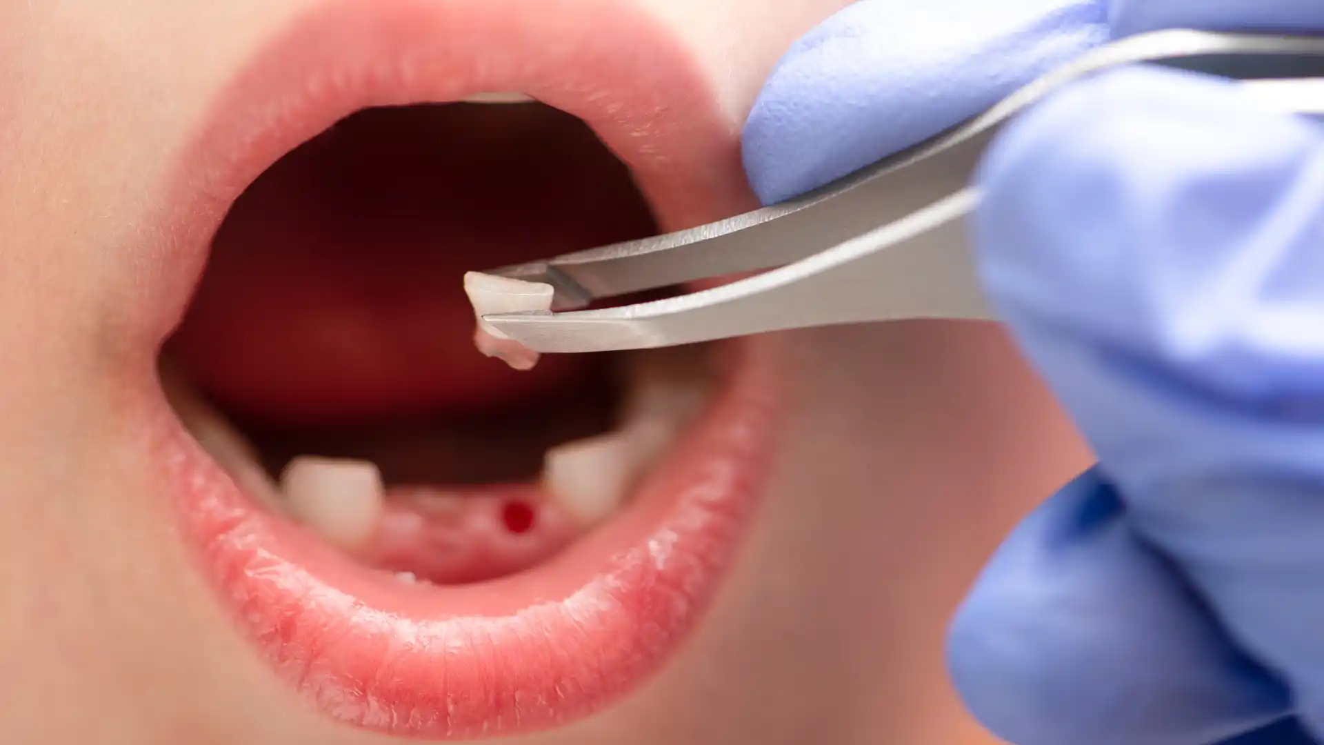 Caring for Your Mouth After Dental Extractions