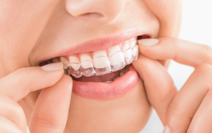 FAQs About Invisalign® Treatment