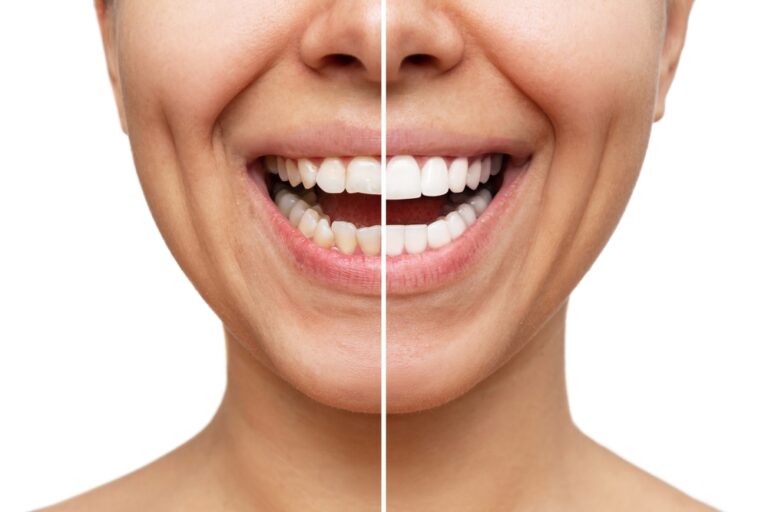 FAQs About Teeth Whitening