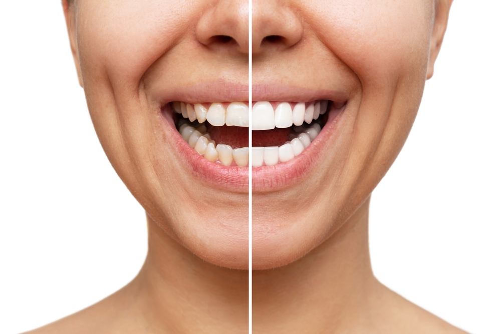 FAQs About Teeth Whitening