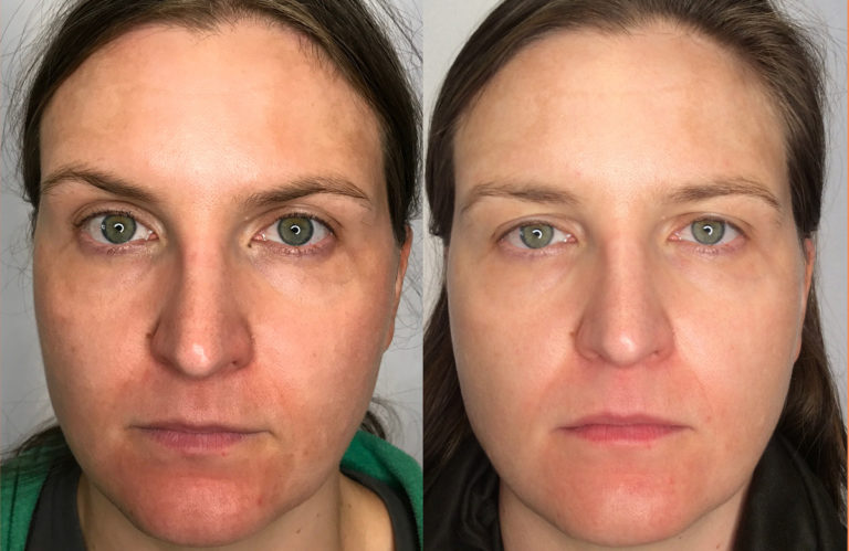 Using Laser Genesis to Treat Redness and Rosacea
