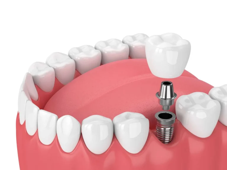 A Guide to Dental Implants and Their Longevity