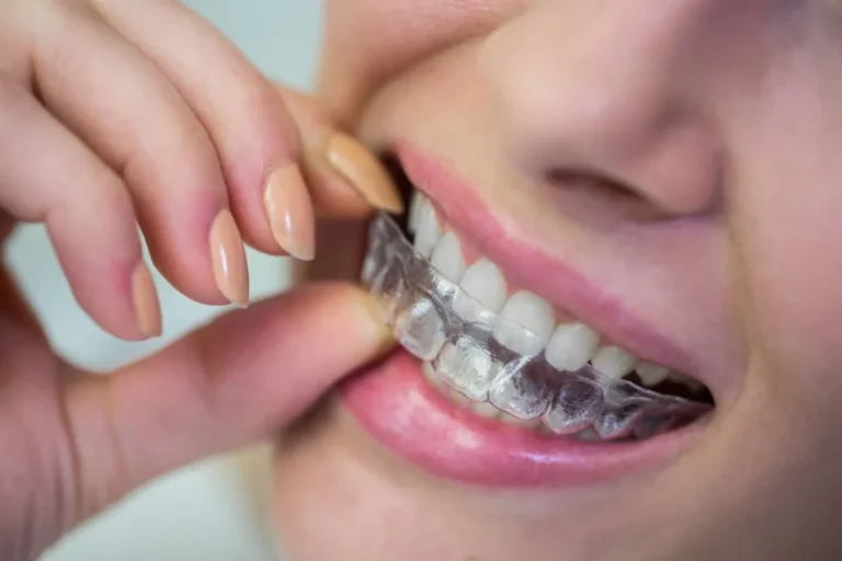 Comparing Invisalign vs. Traditional Braces