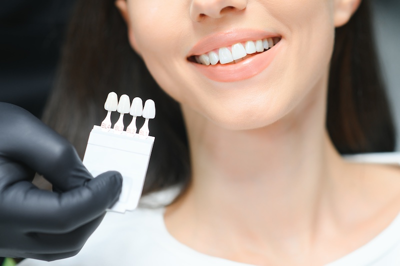 How To Select a Dentist for Veneer Procedures