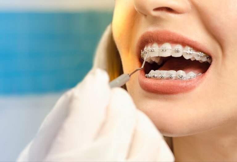 The Benefits of Early Orthodontic Intervention