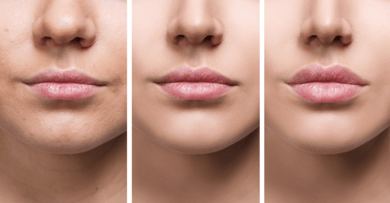 The Role of Dermal Fillers in Appearance