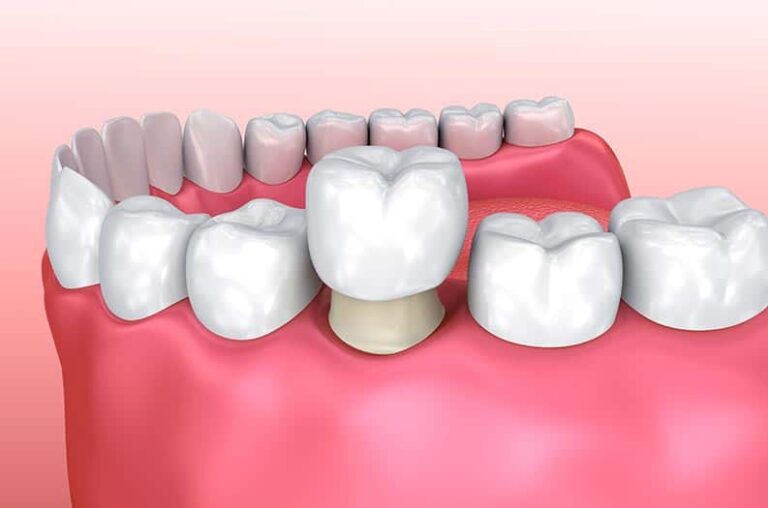 Tips for Maintaining Your Dental Crowns